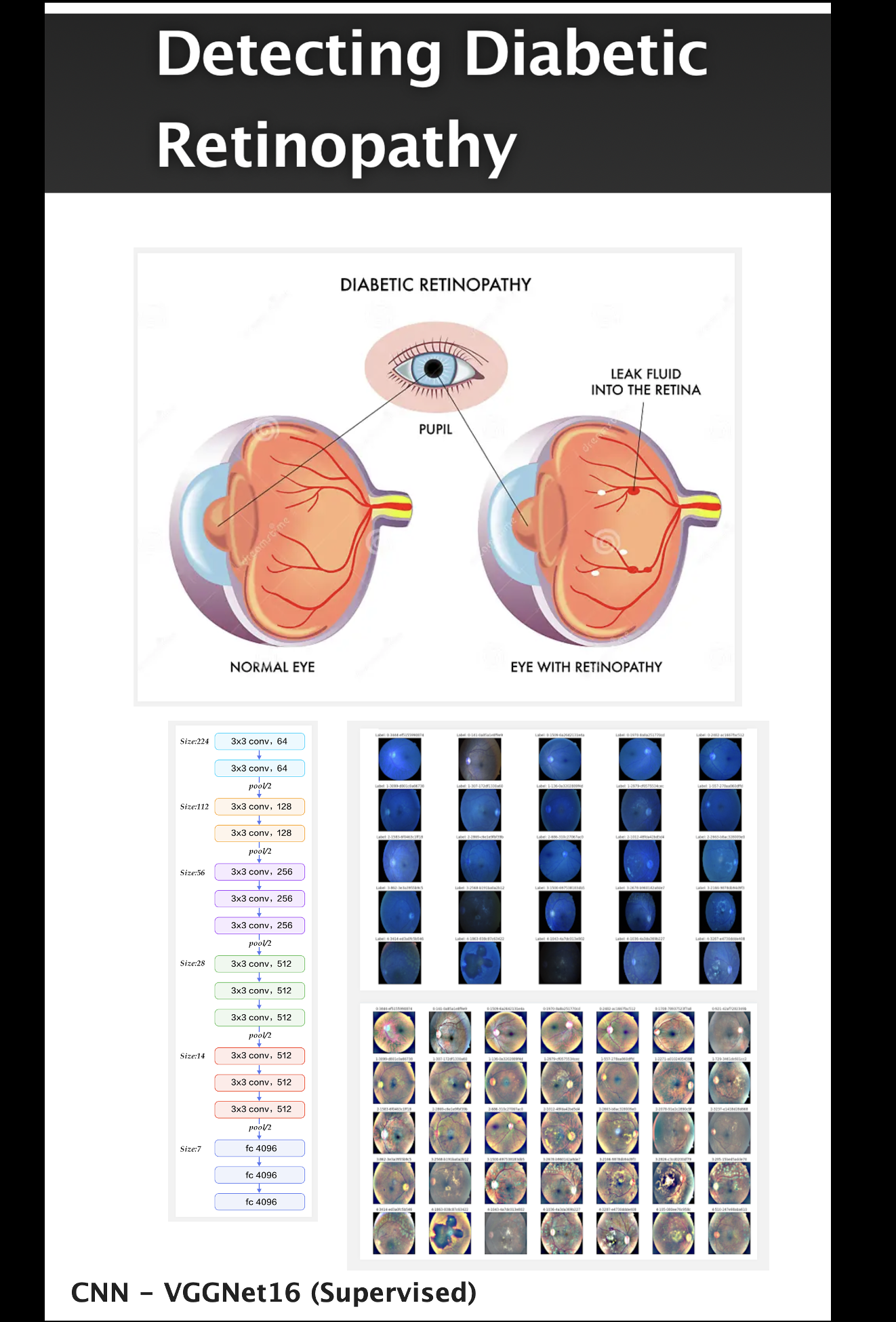 Project - Detecting Diabetic Retinopathy - Deep Learning